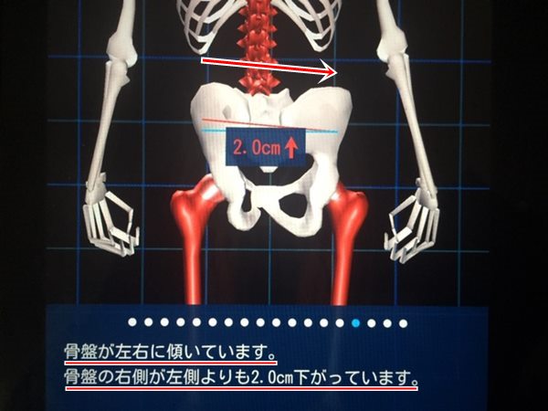 i-body　骨盤